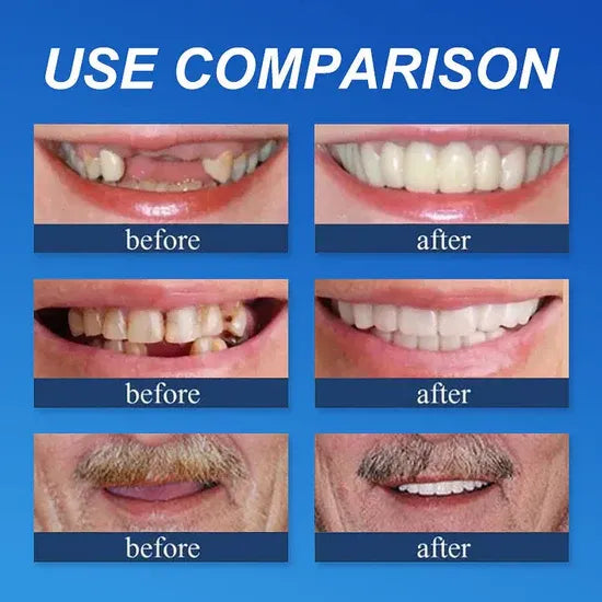 ⏰Ends Today: 70% OFF!  KLENIMORE™ Custom-Fit Smile Support Set — Strong Hold & Natural Look 🦷