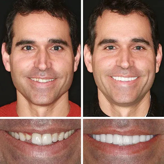 "🎁Ends Today: 70% OFF! ⏰kleanam™ Medical Full Denture with Strong Suctiond🦷Obtain American Dental Association (ADA) Certification
