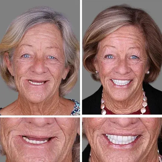 ⏰Ends Today: 70% OFF!  KLENIMORE™ Custom-Fit Smile Support Set — Strong Hold & Natural Look 🦷