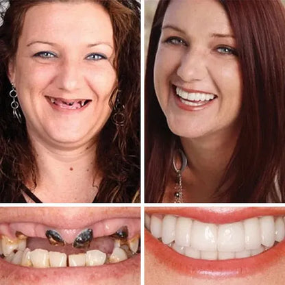 ⏰Ends Today: 70% OFF!  KLENIMORE™ Custom-Fit Smile Support Set — Strong Hold & Natural Look 🦷