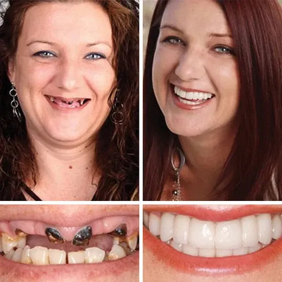 "🎁Ends Today: 70% OFF! ⏰kleanam™ Medical Full Denture with Strong Suctiond🦷Obtain American Dental Association (ADA) Certification